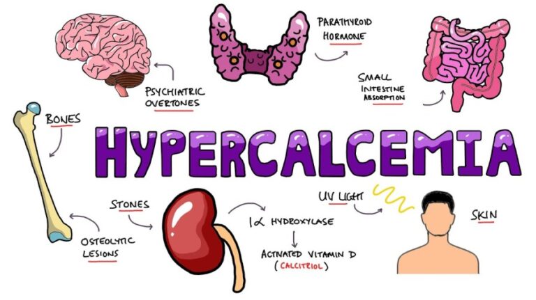 Hypercalcemia Nurses Revision