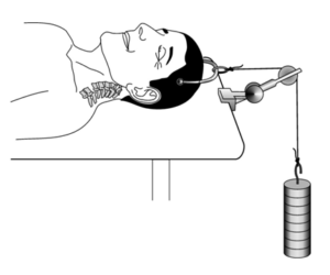 An illustration of a cervical traction with Gardner wells tongs.