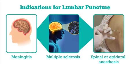 Indications of Lumbar puncture