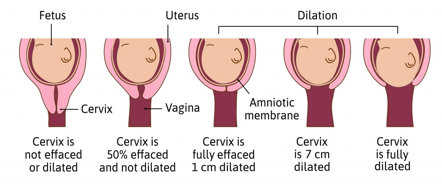 Uterus Inversion - an overview | ScienceDirect Topics