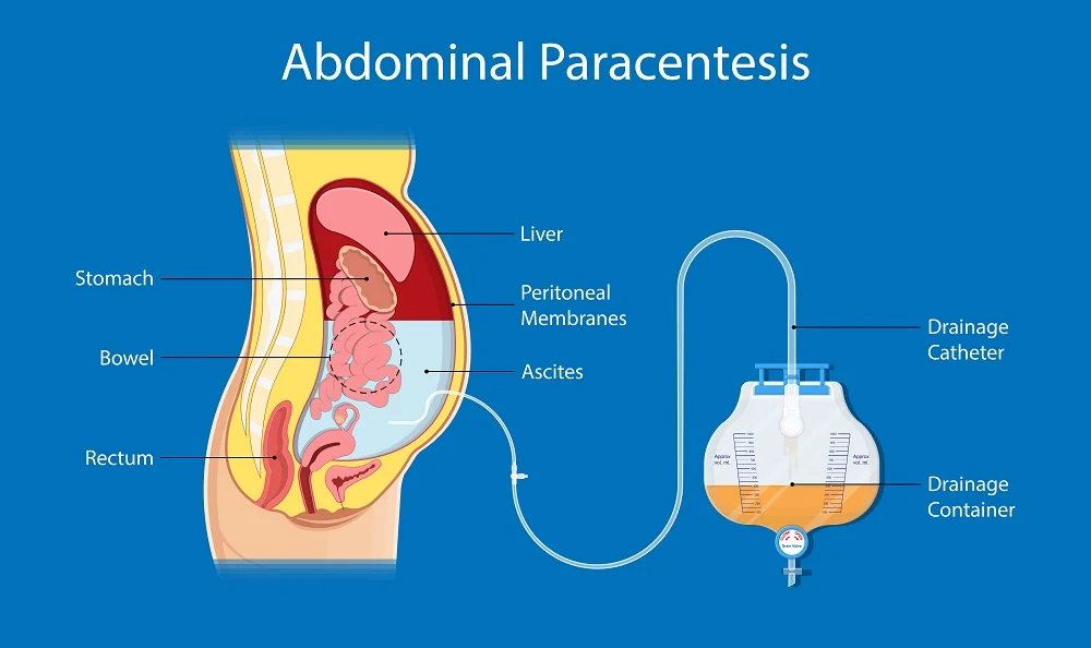 Prepare For Abdominis Paracentesis (Abdominal Tapping)
