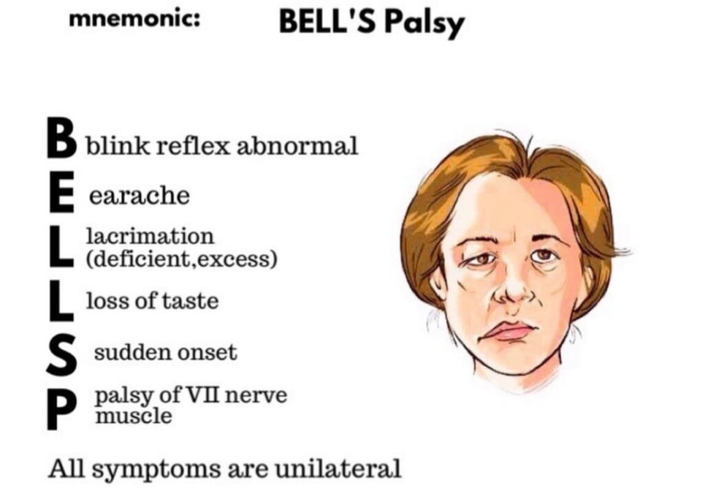 Signs and symptoms of Bells palsy (1)