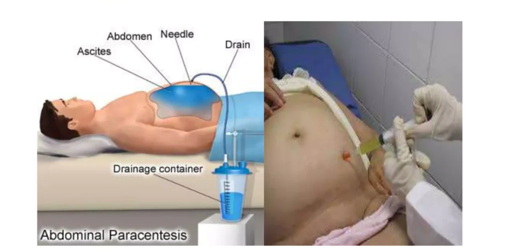Sites and Positioning of Patients for Abdominal Paracentesis