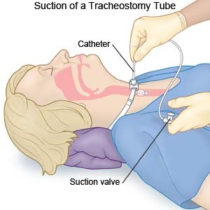 Suctioning procedure