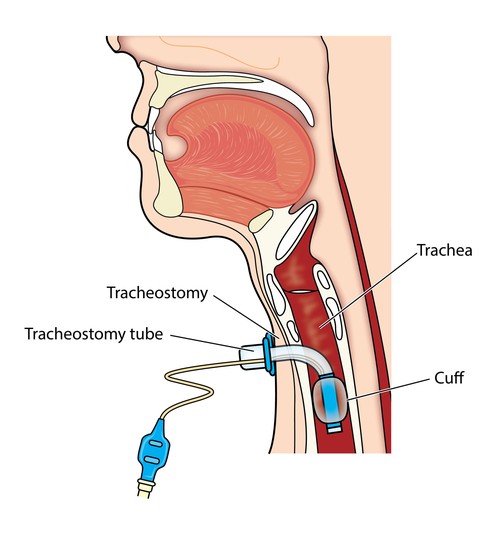 tracheostomy-care