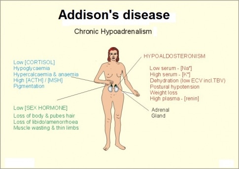 Addison’s disease (Adrenal insufficiency)