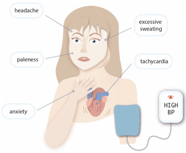 Pheochromocytoma - Nurses Revision