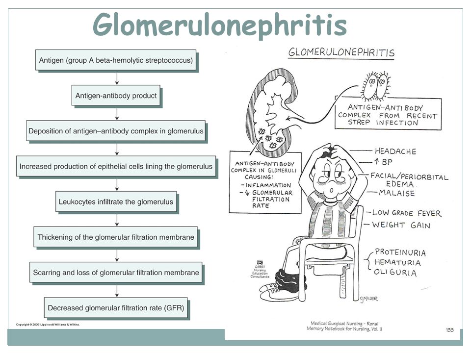 case presentation glomerulonephritis