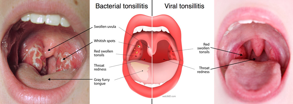 tonsillitis vial bacterial