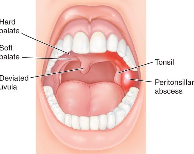 peritonsillar
