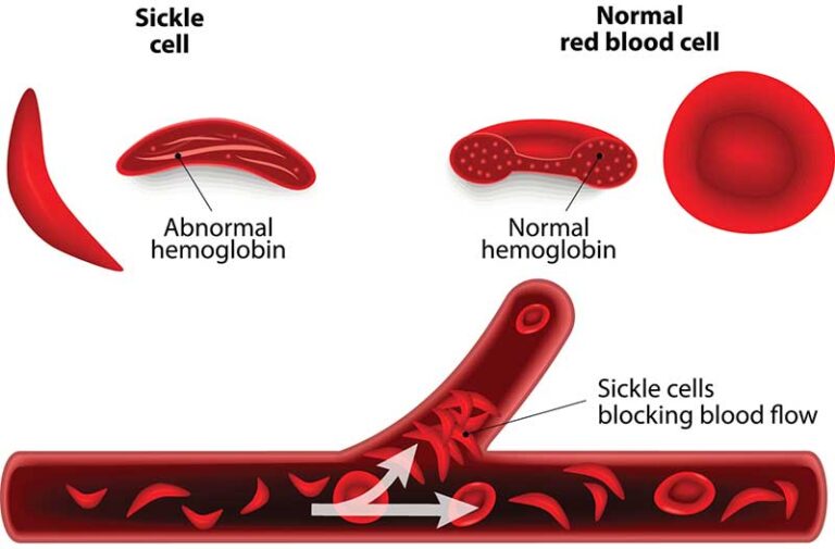 Sickle Cell Disease - Nurses Revision