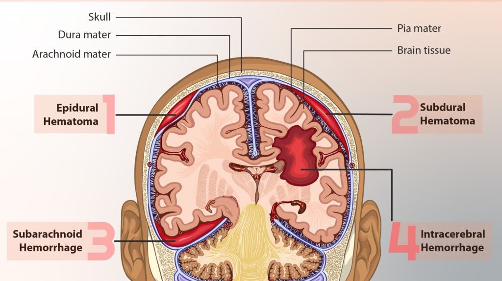 Types of intracranial hemorrhage