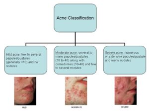 Acne Vulgaris - Nurses Revision