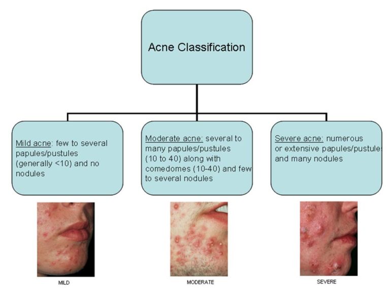 case study 81 acne vulgaris