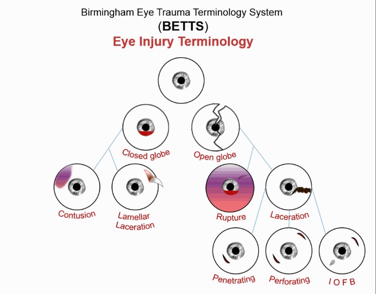 Blunt Trauma To Eye Blunt Trauma To Eye