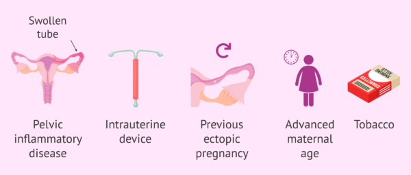 Ectopic Pregnancy - Nurses Revision