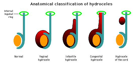 Congenital Hydrocele:

