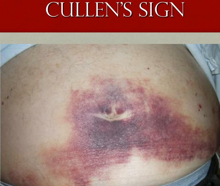 Cullen's Sign ectopic