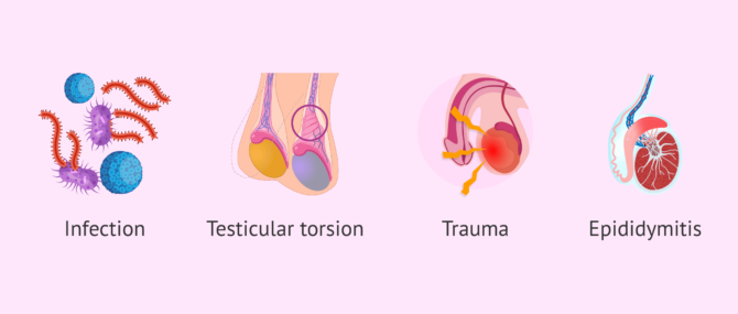 Hydroc le Testiculaire Causes Hydroc le Testiculaire Photos GYMKQ Hydroc le Testiculaire Causes Hydroc le Testiculaire Photos GYMKQ