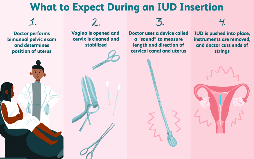 Insertion of an Intrauterine Contraceptive Device (IUD): Procedure