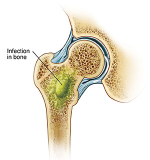 Osteomyelitis