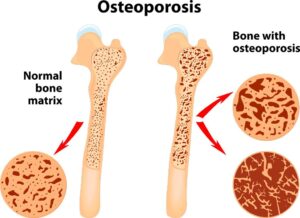 Osteoporosis - Nurses Revision