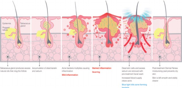 Pathophysiology of acne vulgaris
