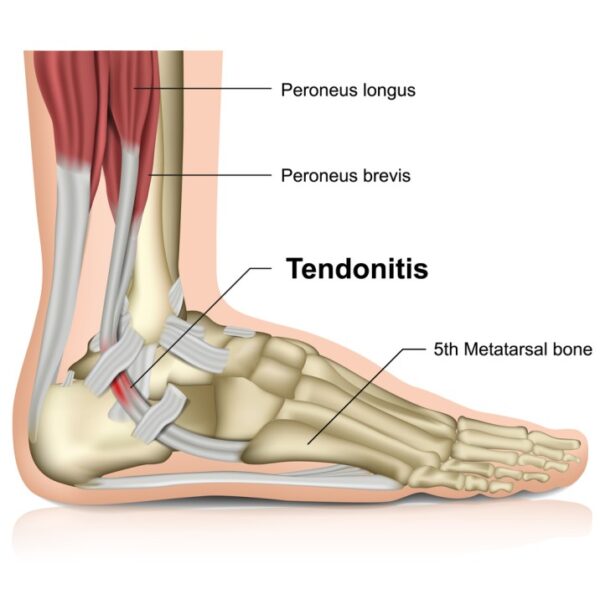 Tendonitis Word Tendonitis - Nurses Revision