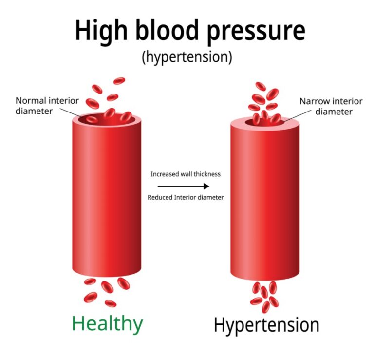 Hypertension - Nurses Revision