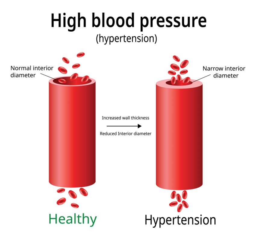 Hypertension high blood pressure