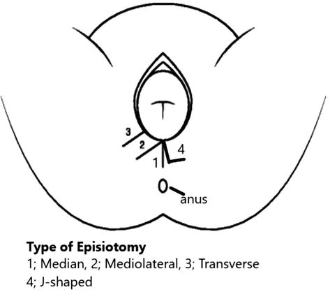 Episiotomy