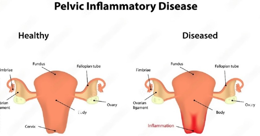 PELVIC INFLAMMATORY DISEASES (PID)