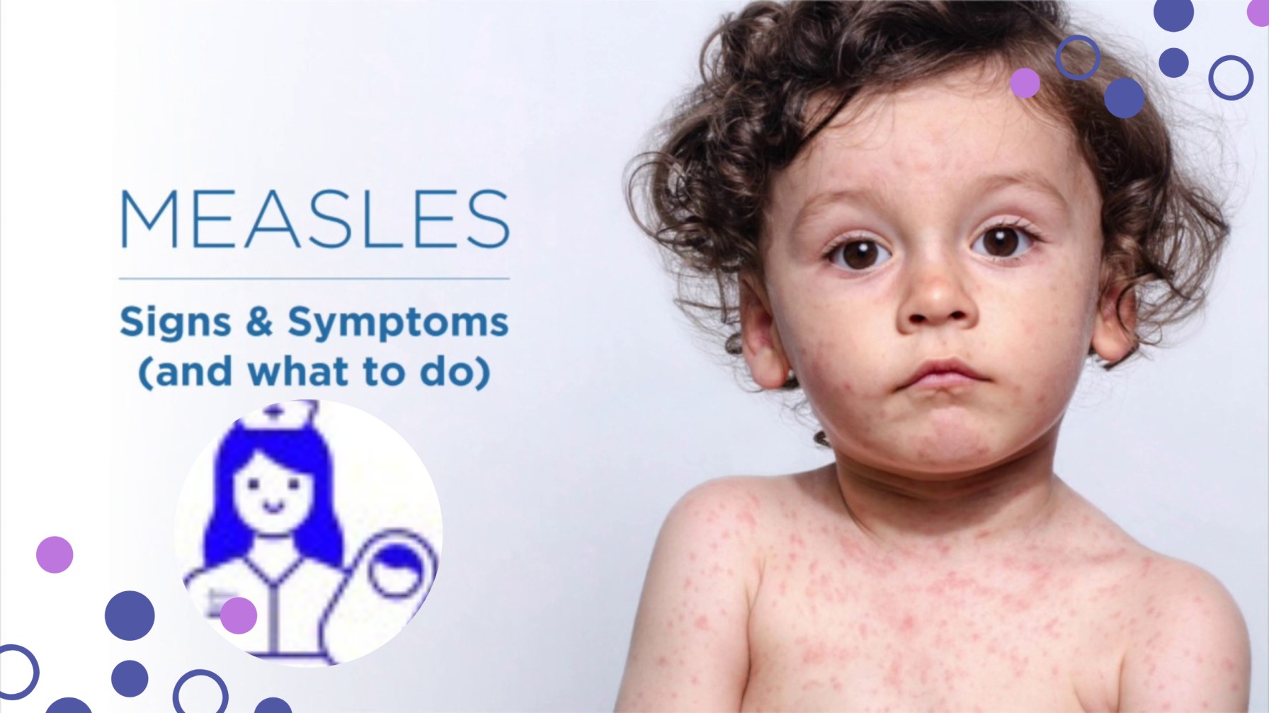 Measles