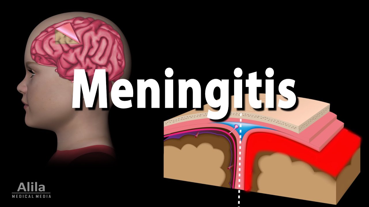 MENINGITIS