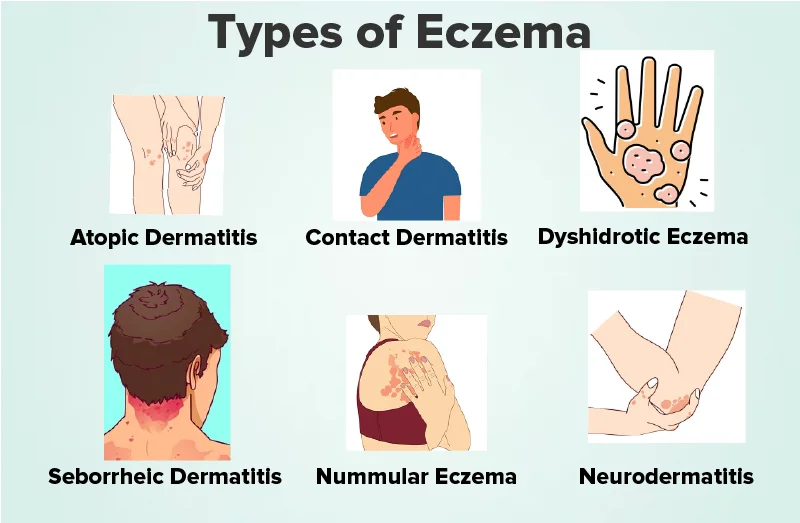 ECZEMA Nurses Revision