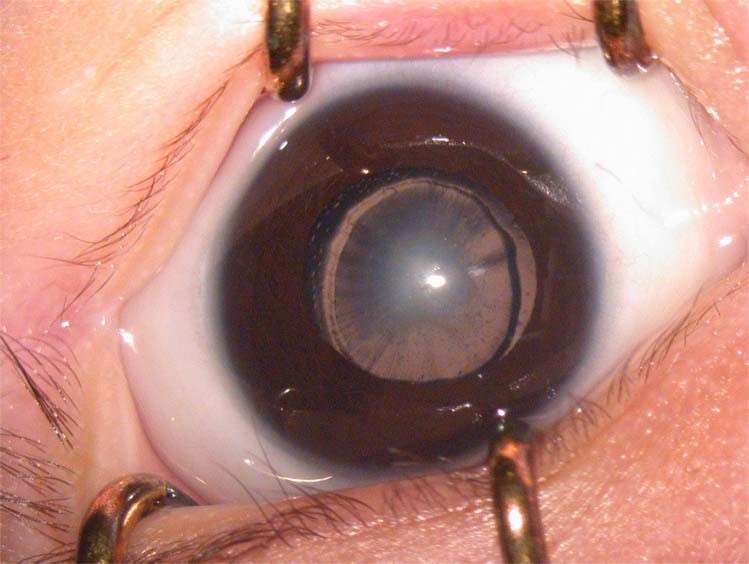 Complications of congenital cataracts