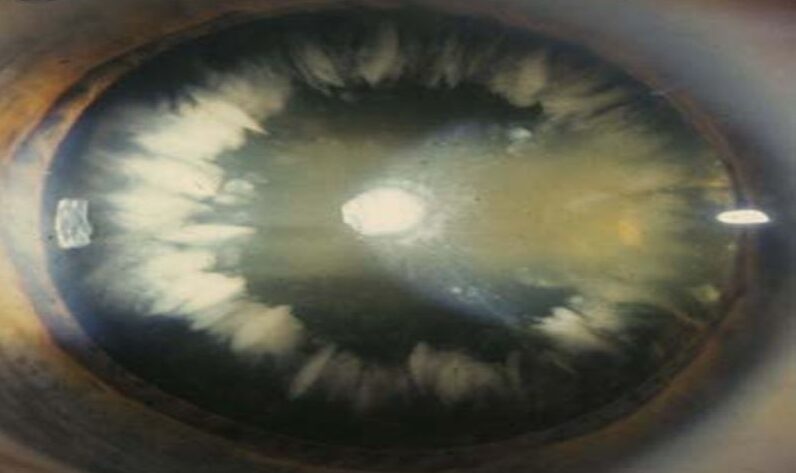 Coronary Cataract: 