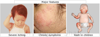 Diagnosis of Eczema.