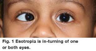 Esotropia