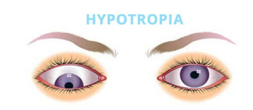 Hypotropia