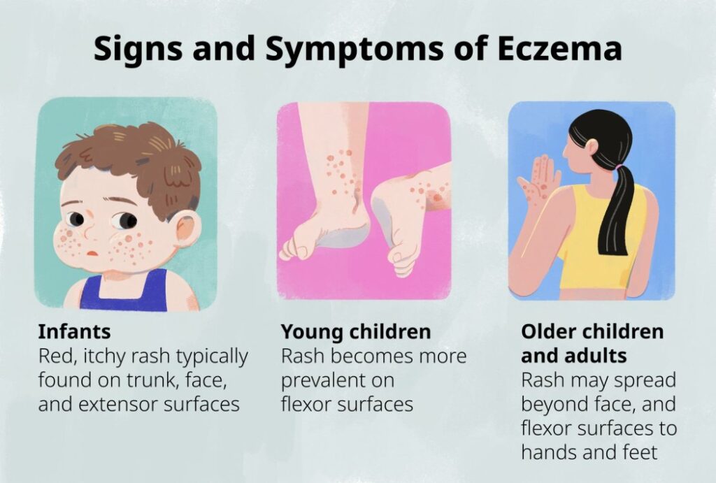 Symptoms of atopic eczema vary across different age groups: