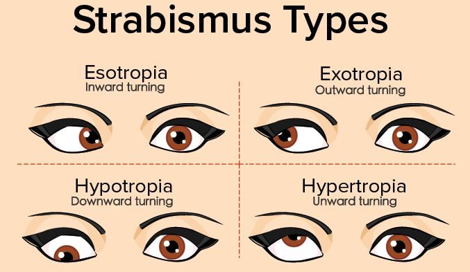 Types of Strabismus