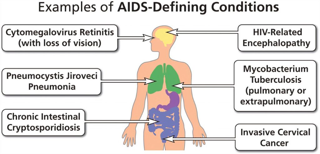 OPPORTUNISTIC INFECTIONS IN HIV/AIDS