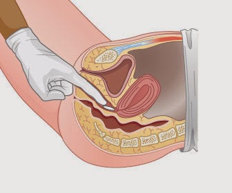 ADMINISTERING RECTAL AND VAGINAL MEDICATION.