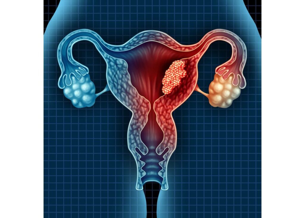 Cancers of Reproductive Health Organs