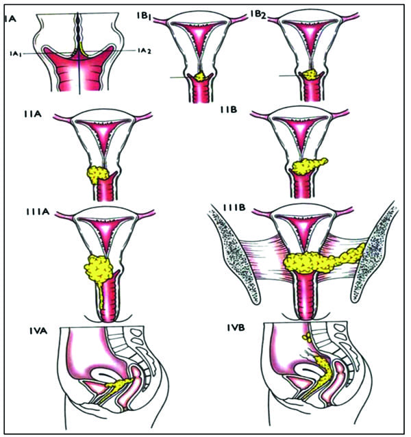 cervical cancer staging