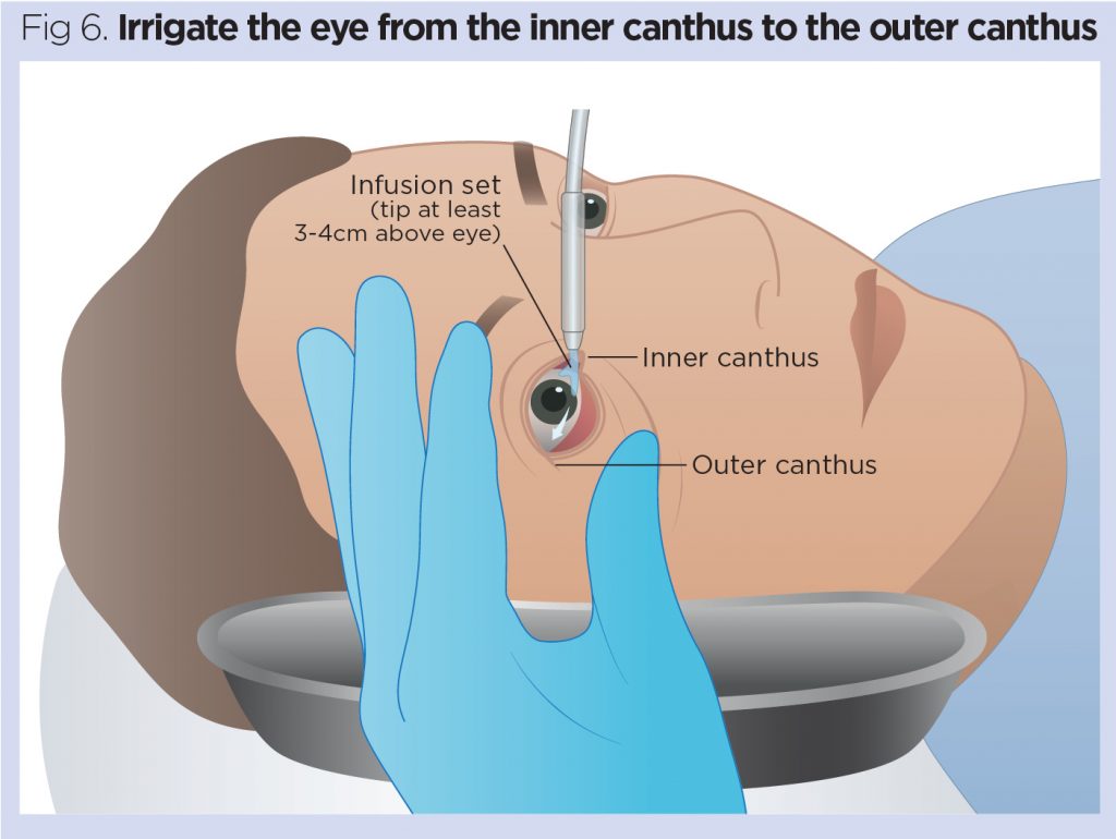 Eye Irrigation