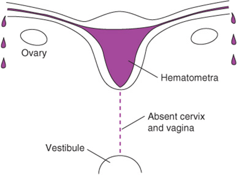 Cervical Agenesis