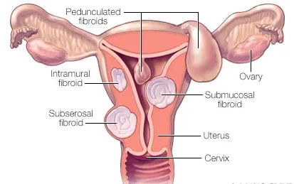 Classes or types of Uterine fibroids Submucosal Fibroids: These fibroids grow into the uterine cavity. They are located just beneath the inner lining of the uterus (endometrium). Submucosal fibroids can cause various symptoms, including heavy menstrual bleeding and infertility. Intramural Fibroids (Interstitial): Intramural fibroids are the most common type and grow within the muscular wall of the uterus, known as the myometrium. They may expand and distort the shape of the uterus, leading to pain, pressure, and other symptoms. Subserosal Fibroids: These fibroids grow on the outside surface of the uterus. They can project outward and may become quite large. Subserosal fibroids can cause pelvic pain and pressure on nearby organs. Cervical Fibroids: Located on the cervix, the lower part of the uterus, cervical fibroids are relatively rare. They may cause symptoms such as pain and discomfort, and in some cases, they can affect fertility or lead to difficulties during labor. Pedunculated Fibroids: These fibroids are attached to the uterus by a narrow stalk or pedicel that contains blood vessels. Pedunculated fibroids can be either subserosal or submucous, depending on their location. Fibroid of the Broad Ligament: This type of fibroid develops in the broad ligament, which is a supportive structure that helps hold the uterus in place within the pelvis. Broad ligament fibroids are relatively uncommon and may require specific management depending on their size and location.