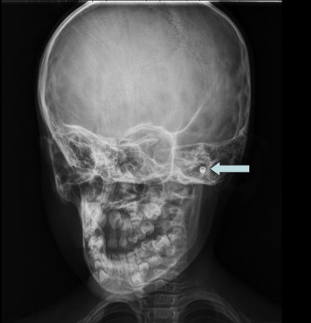 Diagnosis and Investigations of Foreign Bodies in the Ear: